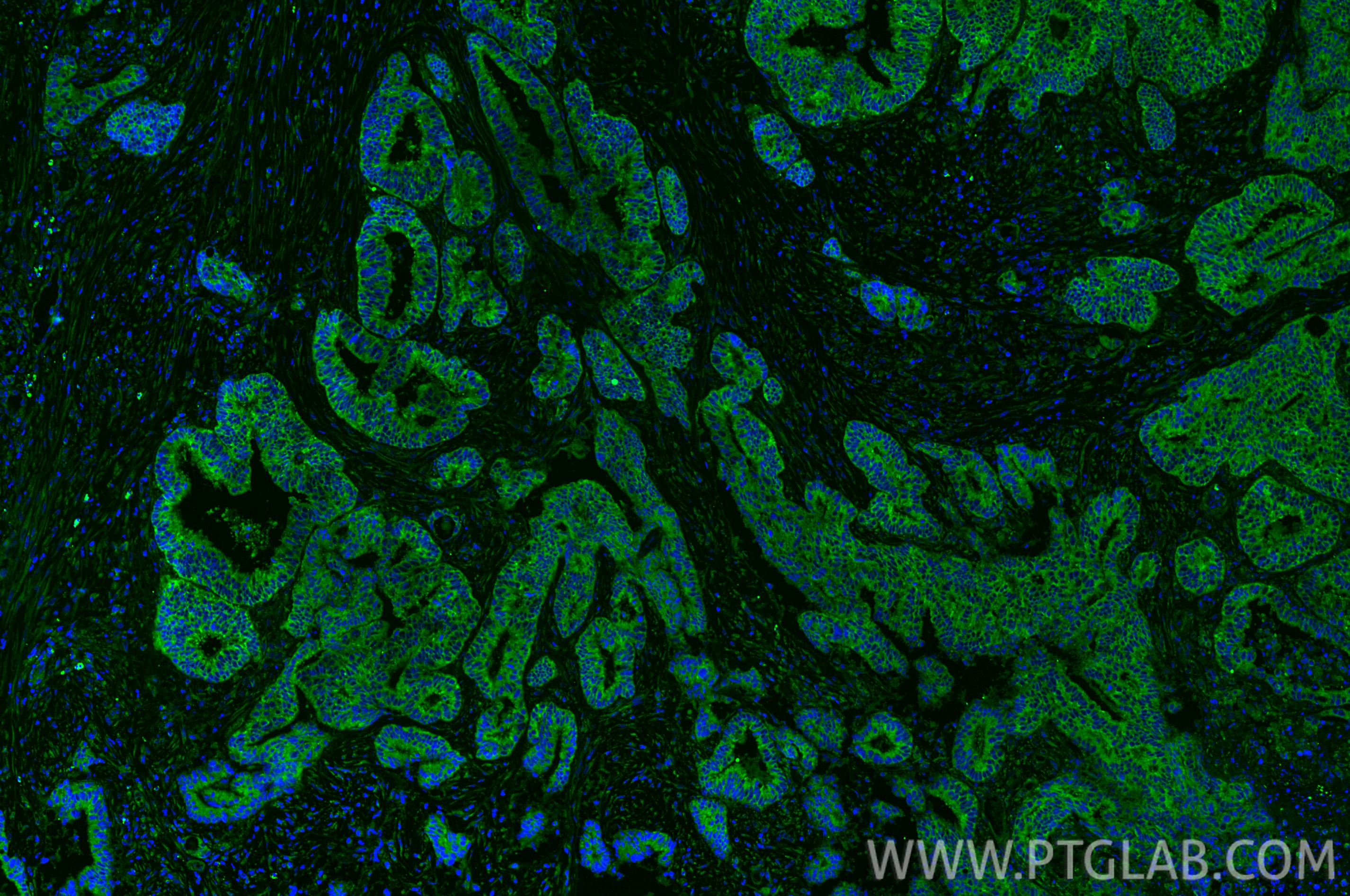Immunofluorescence (IF) / fluorescent staining of human colon cancer tissue using Bcl2 Recombinant monoclonal antibody (82469-6-RR)