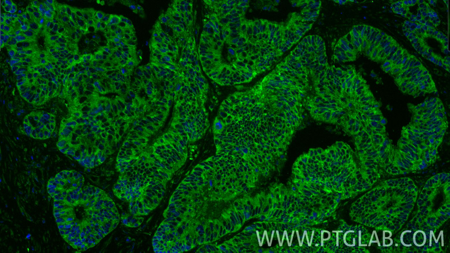 Immunofluorescence (IF) / fluorescent staining of human colon cancer tissue using Bcl2 Recombinant monoclonal antibody (82469-6-RR)