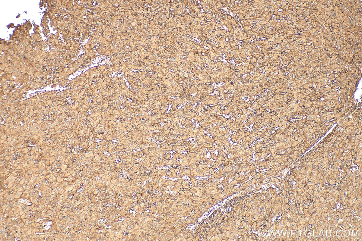 Immunohistochemistry (IHC) staining of human liver cancer tissue using Beta-2-Microglobulin Polyclonal antibody (30226-1-AP)