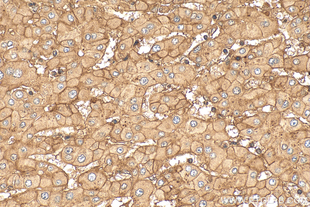 Immunohistochemistry (IHC) staining of human liver cancer tissue using Beta-2-Microglobulin Polyclonal antibody (30226-1-AP)