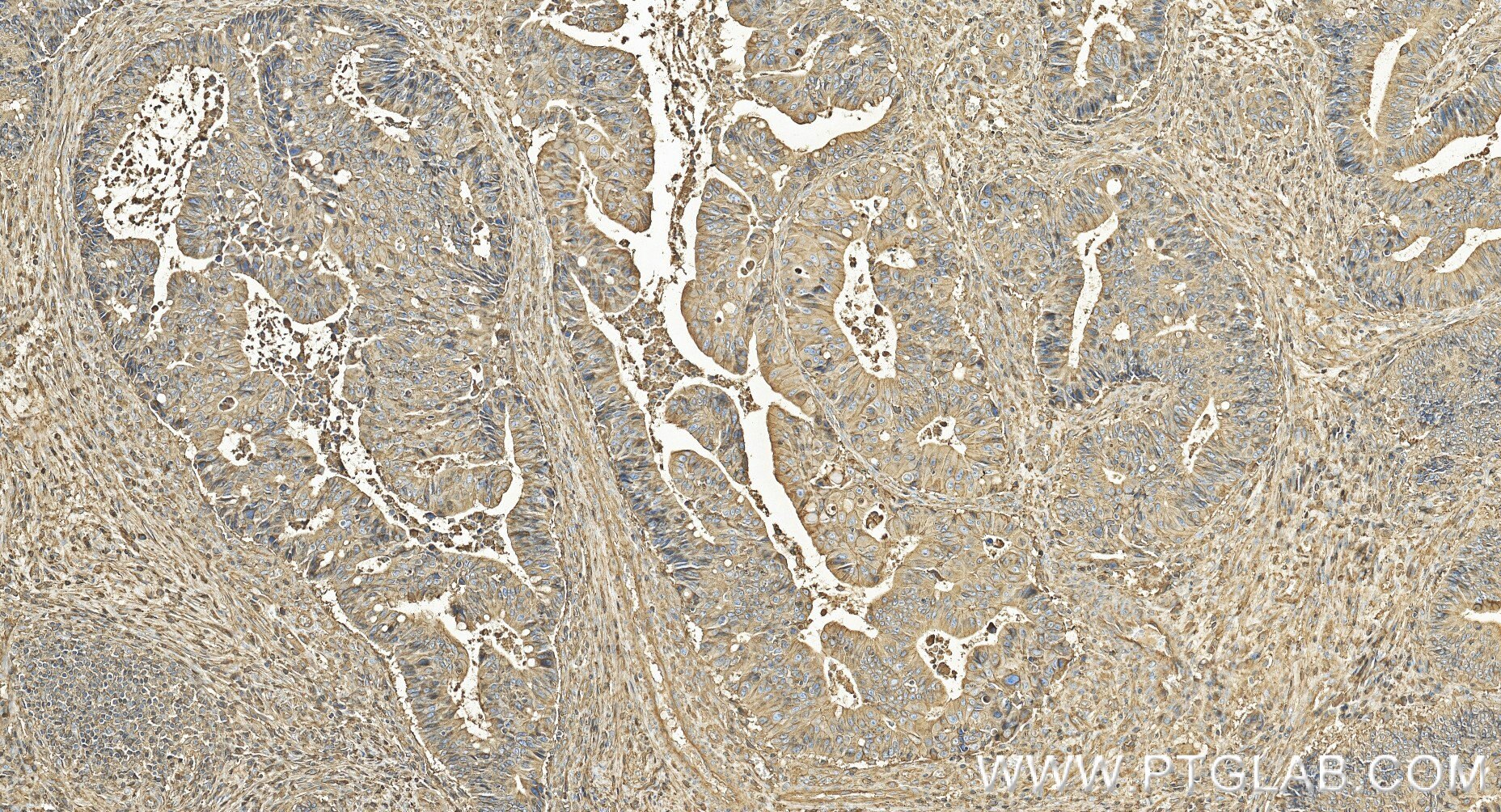 Immunohistochemistry (IHC) staining of human colon cancer tissue using Beta-2-Microglobulin Recombinant monoclonal antibo (83683-6-RR)