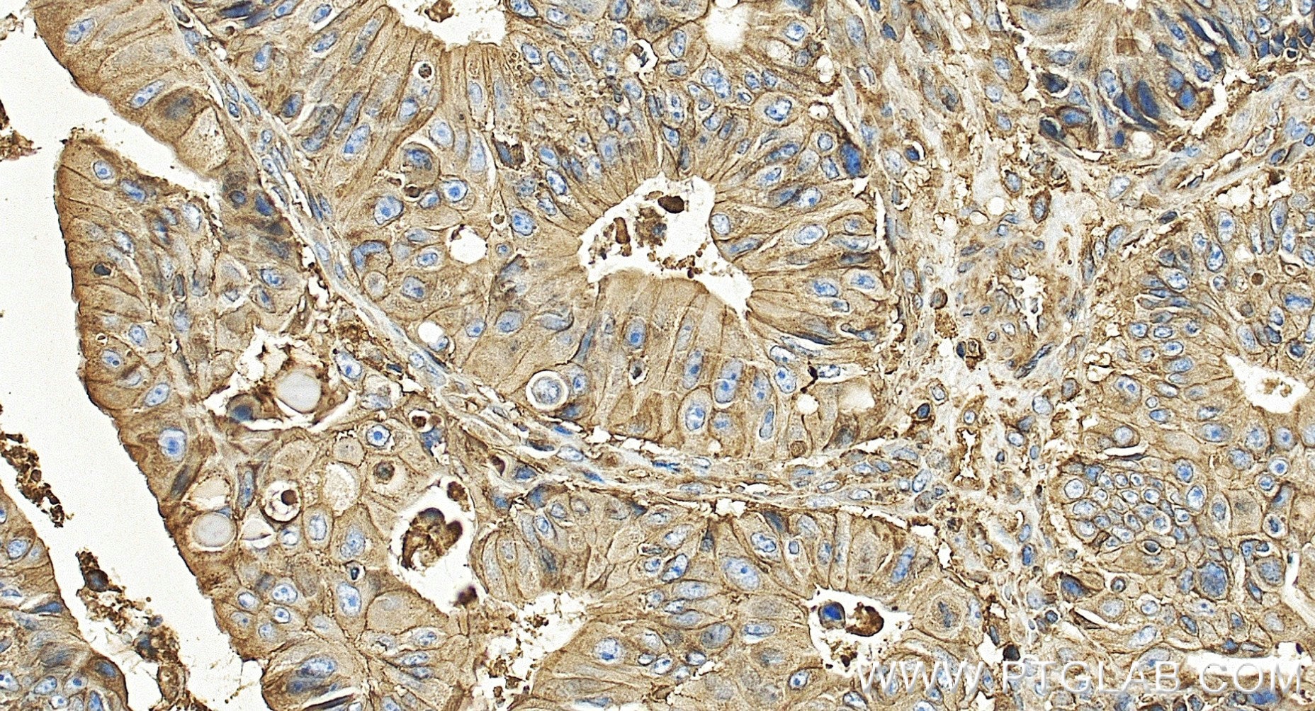 Immunohistochemistry (IHC) staining of human colon cancer tissue using Beta-2-Microglobulin Recombinant monoclonal antibo (83683-6-RR)