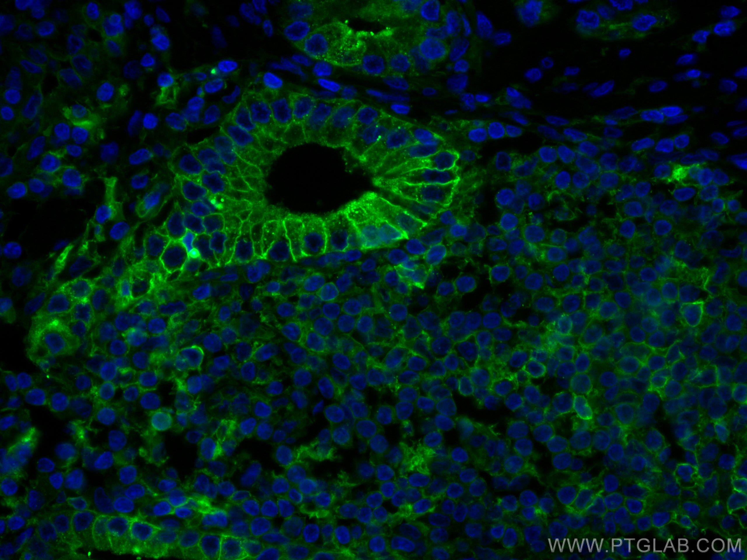 Immunofluorescence (IF) / fluorescent staining of human prostate cancer tissue using CoraLite® Plus 488-conjugated Beta-2-Microglobulin (CL488-66207)