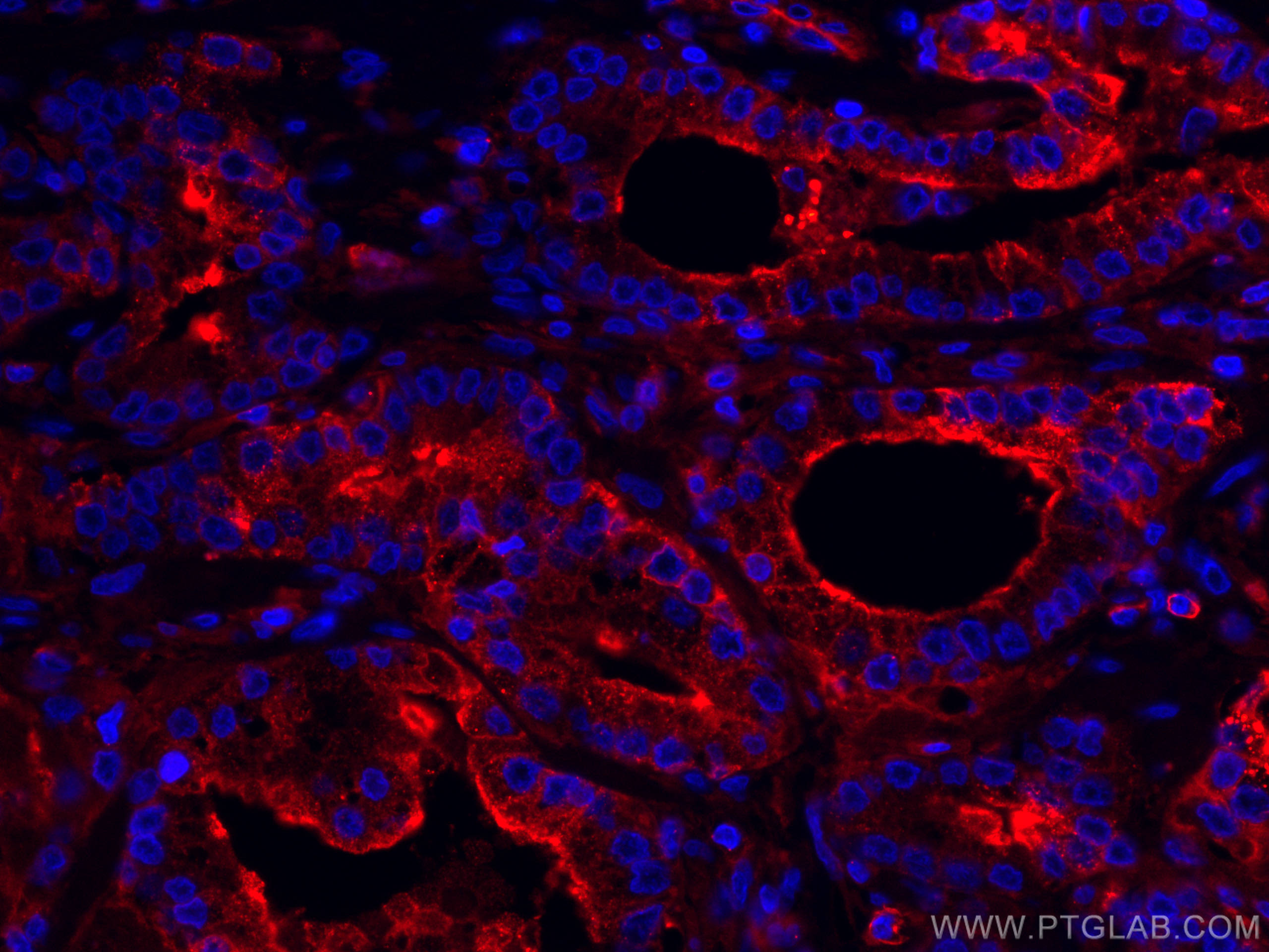 Immunofluorescence (IF) / fluorescent staining of human prostate cancer tissue using CoraLite®594-conjugated Beta-2-Microglobulin Monoc (CL594-66207)