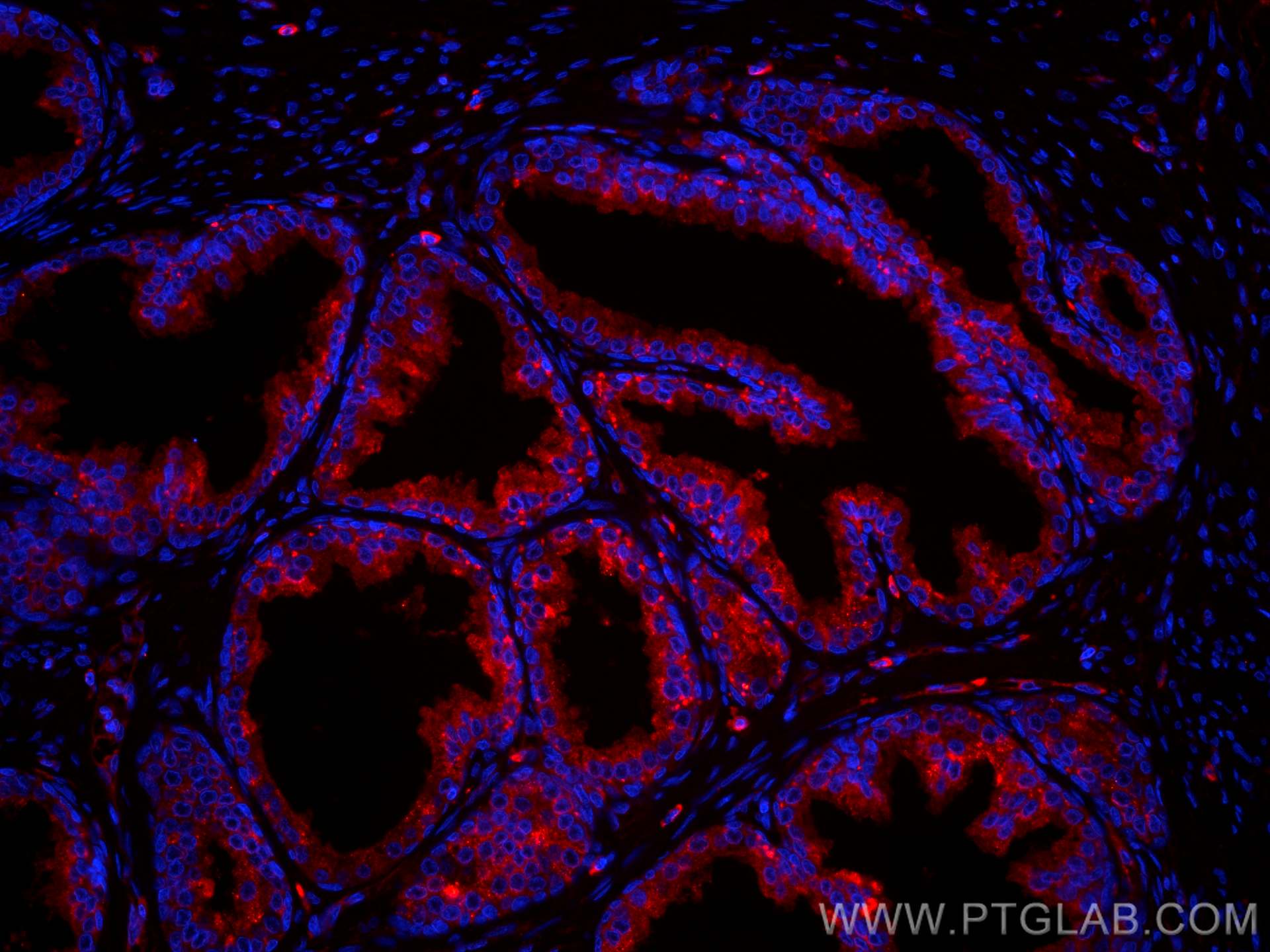 Immunofluorescence (IF) / fluorescent staining of human prostate cancer tissue using CoraLite®594-conjugated Beta-2-Microglobulin Monoc (CL594-66207)
