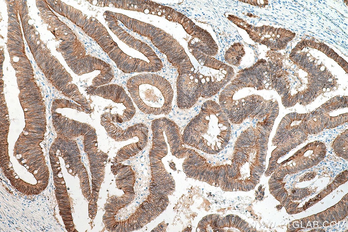 Immunohistochemistry (IHC) staining of human colon cancer tissue using Beta Catenin Recombinant antibody (80488-1-RR)