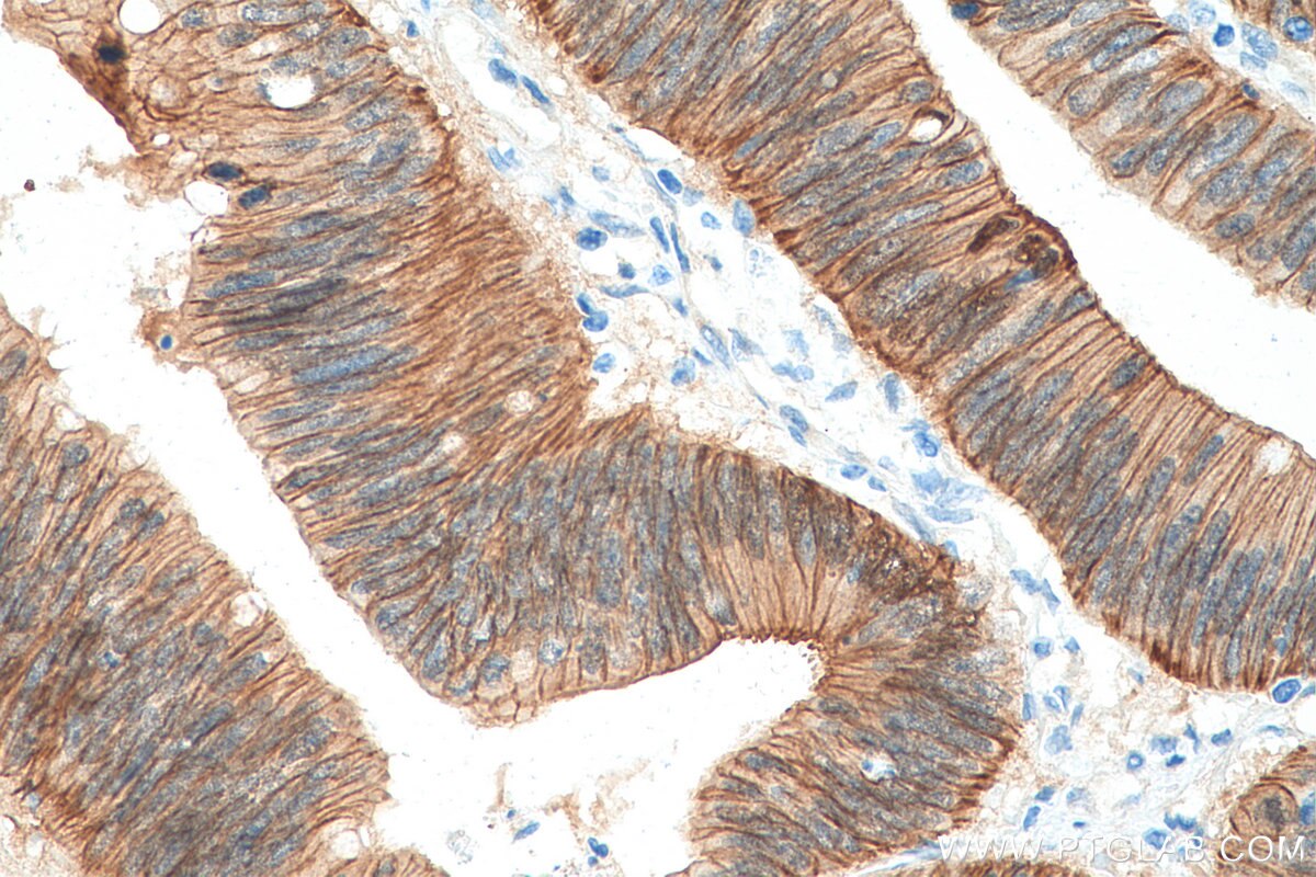 Immunohistochemistry (IHC) staining of human colon cancer tissue using Beta Catenin Recombinant antibody (80488-1-RR)