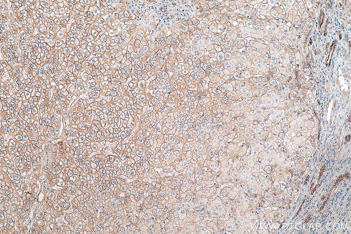 Immunohistochemistry (IHC) staining of human liver cancer tissue using Beta Catenin Recombinant antibody (80488-1-RR)