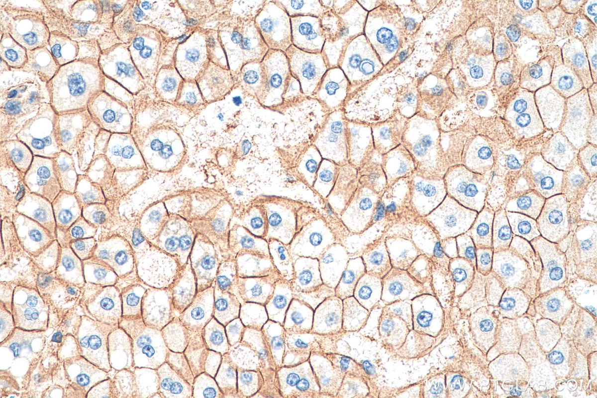 Immunohistochemistry (IHC) staining of human liver cancer tissue using Beta Catenin Recombinant antibody (80488-1-RR)