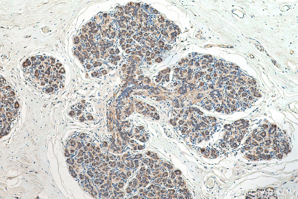 IHC staining of human breast cancer using 80488-1-RR
