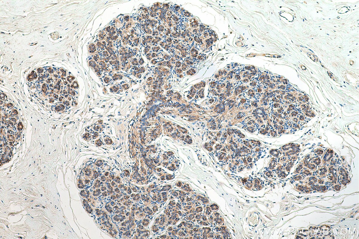 Immunohistochemistry (IHC) staining of human breast cancer tissue using Beta Catenin Recombinant antibody (80488-1-RR)