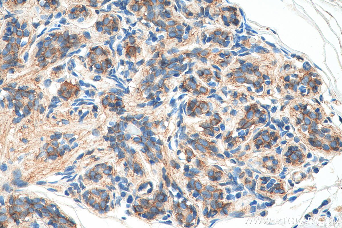 Immunohistochemistry (IHC) staining of human breast cancer tissue using Beta Catenin Recombinant antibody (80488-1-RR)