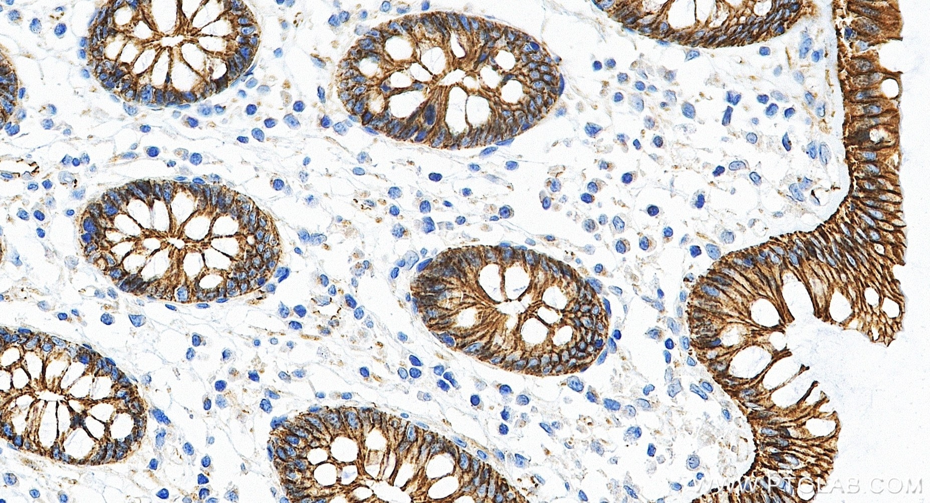 Immunohistochemistry (IHC) staining of human colon tissue using Beta Catenin Recombinant monoclonal antibody (80508-1-RR)