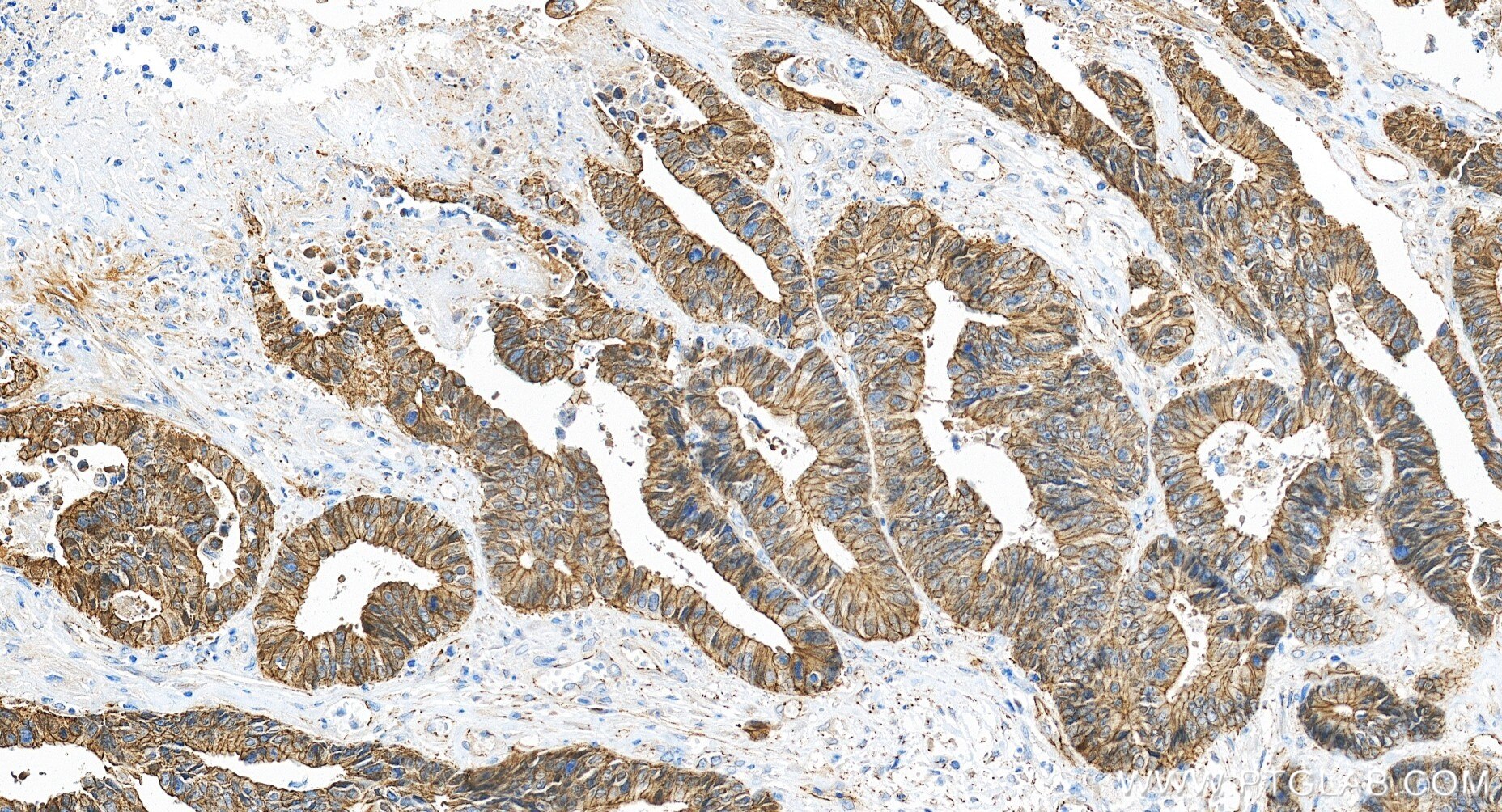 Immunohistochemistry (IHC) staining of human colon cancer tissue using Beta Catenin Recombinant monoclonal antibody (80508-1-RR)