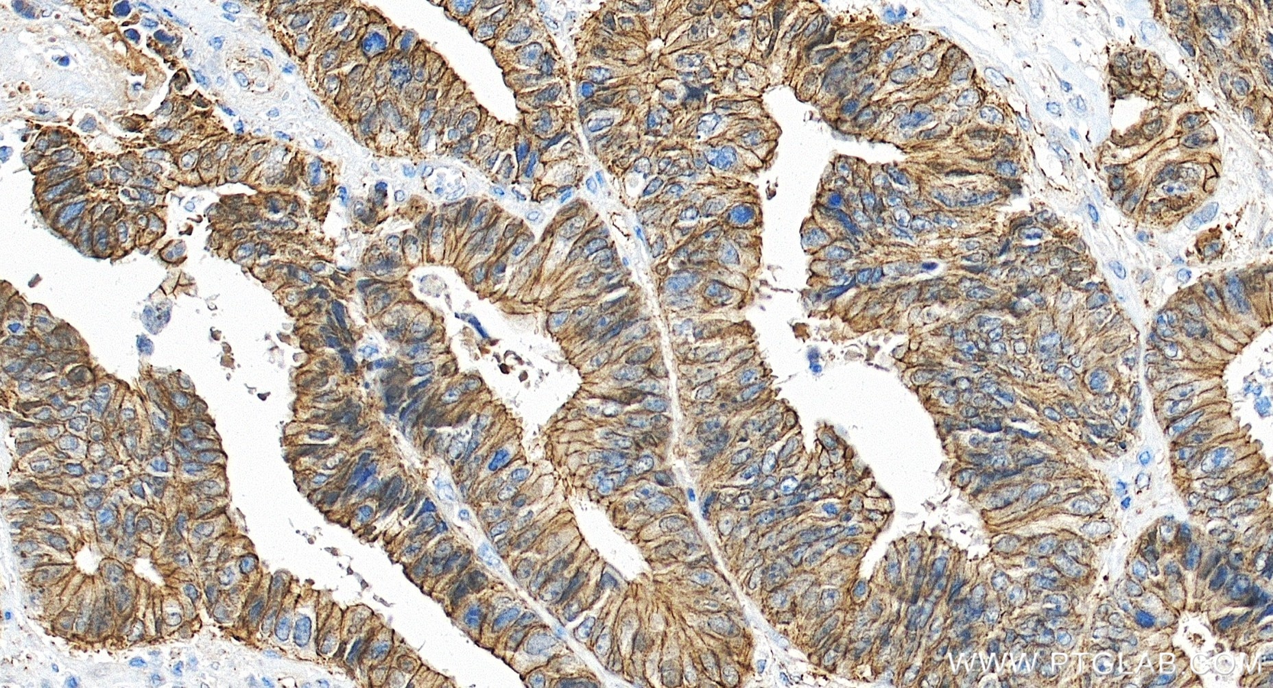 Immunohistochemistry (IHC) staining of human colon cancer tissue using Beta Catenin Recombinant monoclonal antibody (80508-1-RR)