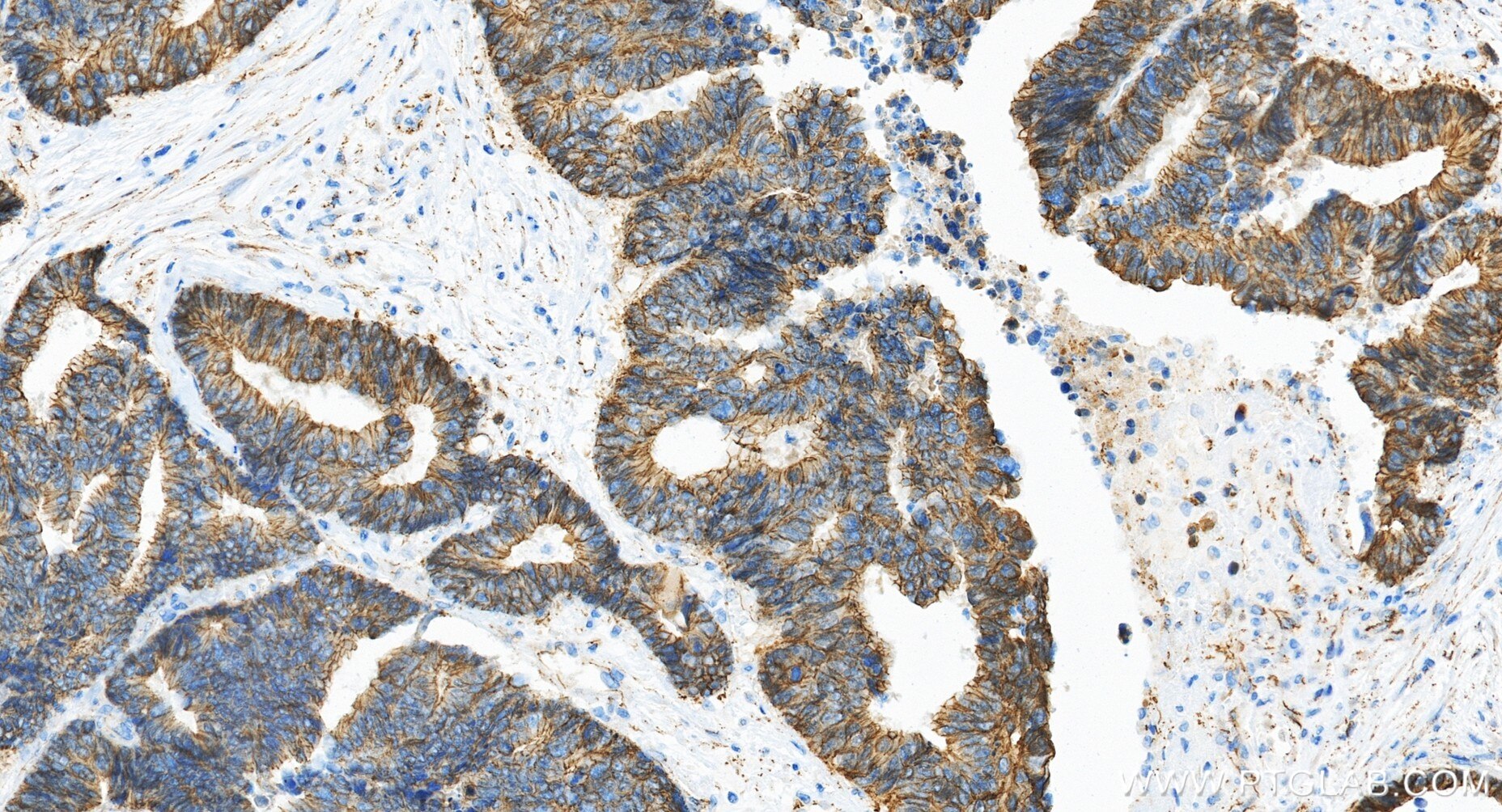 Immunohistochemistry (IHC) staining of human colon cancer tissue using Beta Catenin Recombinant monoclonal antibody (80508-1-RR)