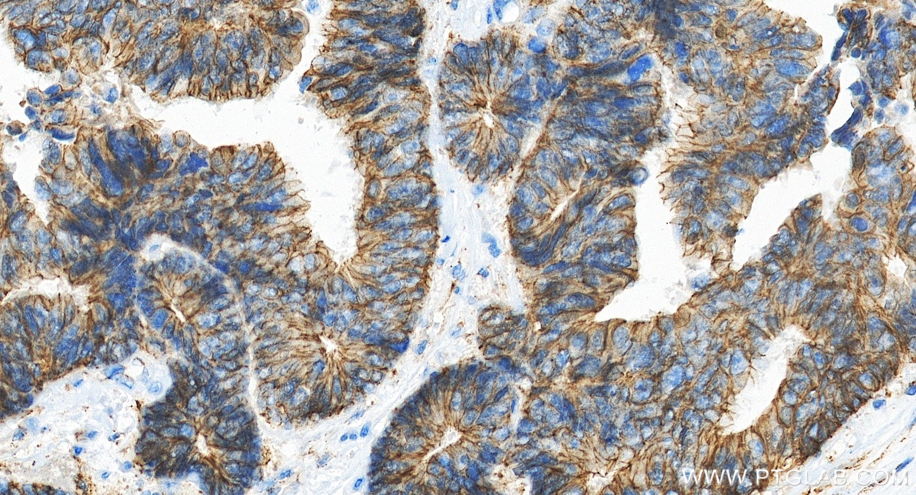 Immunohistochemistry (IHC) staining of human colon cancer tissue using Beta Catenin Recombinant monoclonal antibody (80508-1-RR)