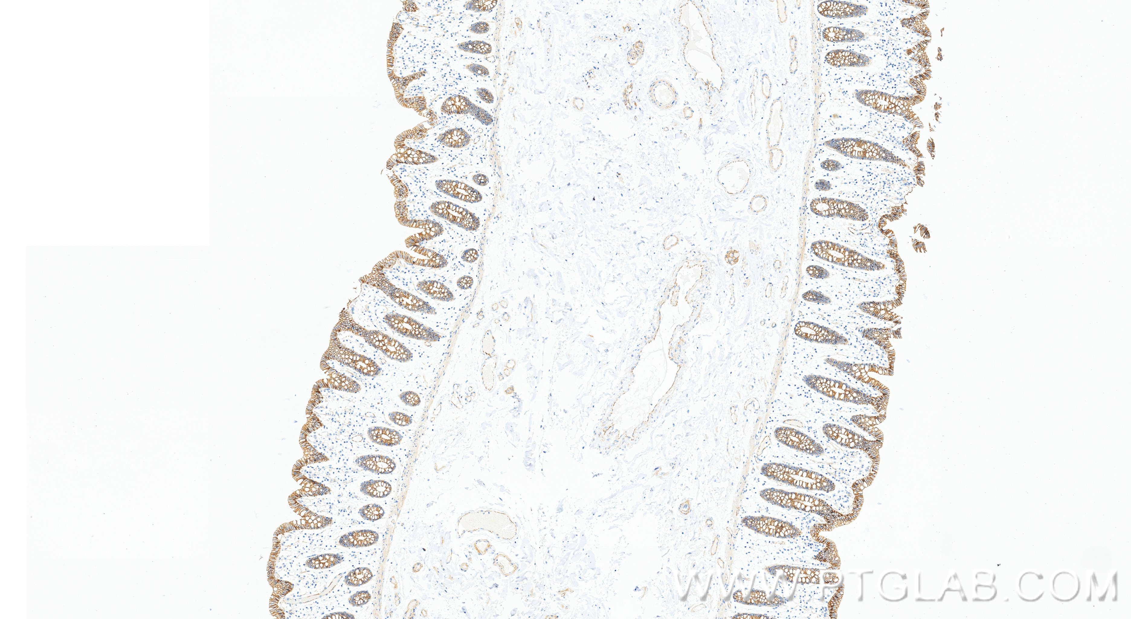 IHC staining of human colon using 98860-3-RR Immunohistochemistry (IHC) staining of human colon tissue using Anti-Human Beta Catenin Rabbit Recombinant Antibod (98860-3-RR)