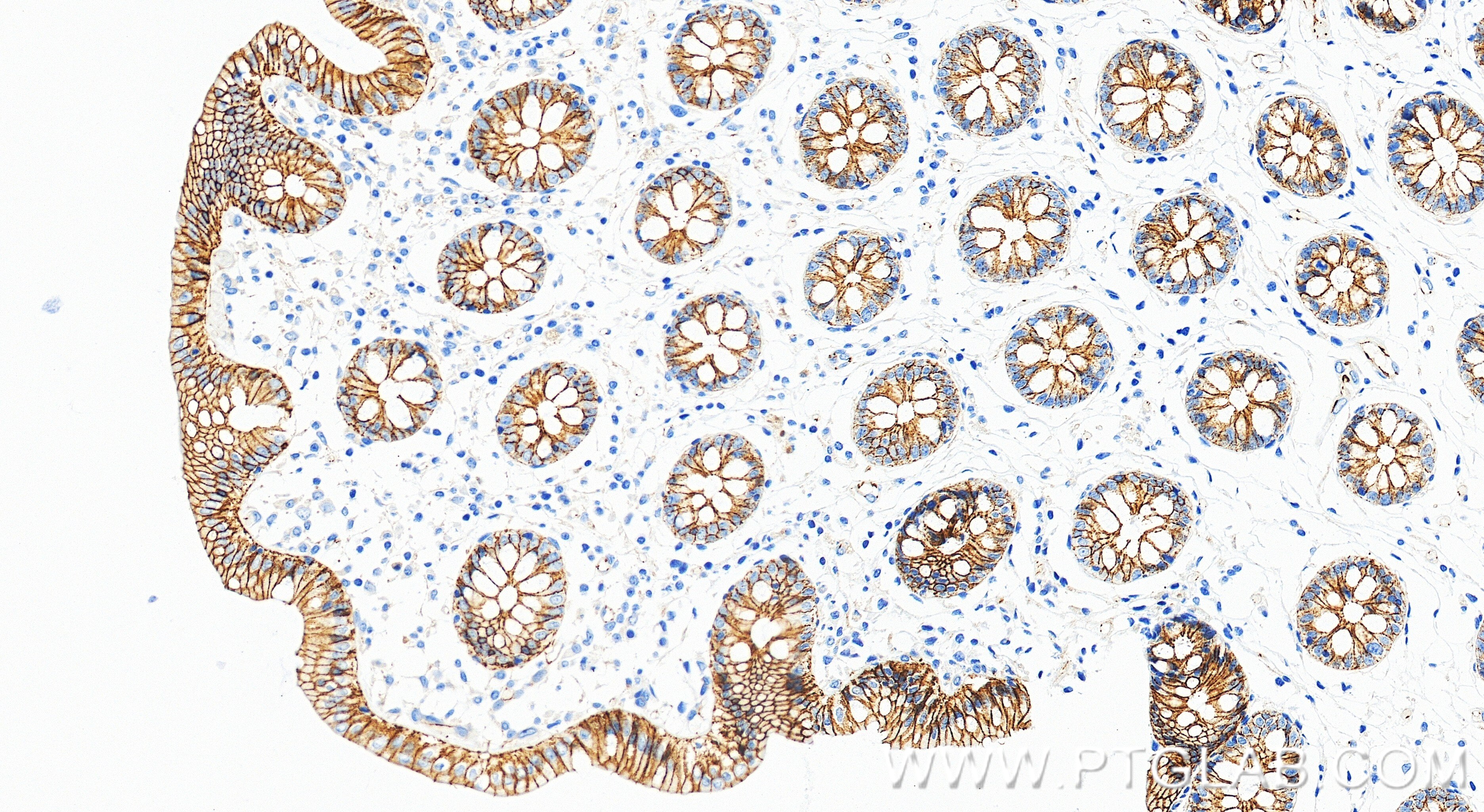 IHC staining of human colon using 98860-3-RR Immunohistochemistry (IHC) staining of human colon tissue using Anti-Human Beta Catenin Rabbit Recombinant Antibod (98860-3-RR)