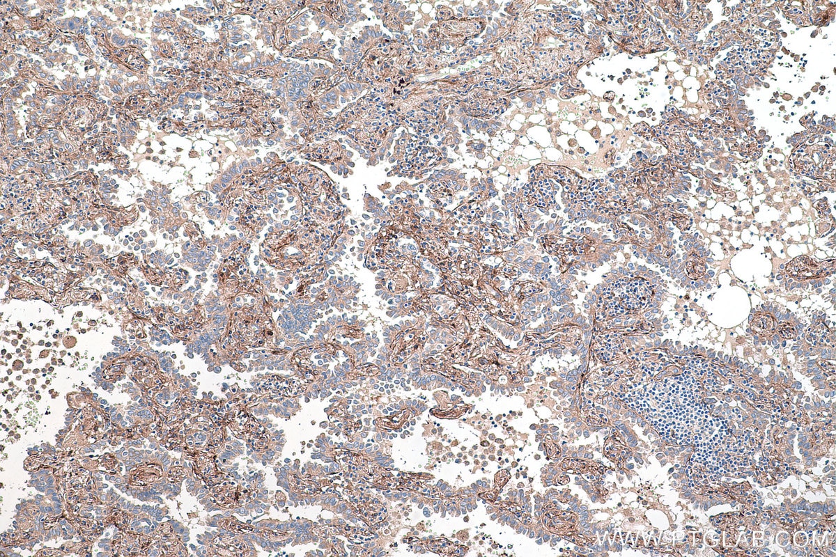 Immunohistochemistry (IHC) staining of human lung cancer tissue using Biglycan Monoclonal antibody (67275-1-Ig)