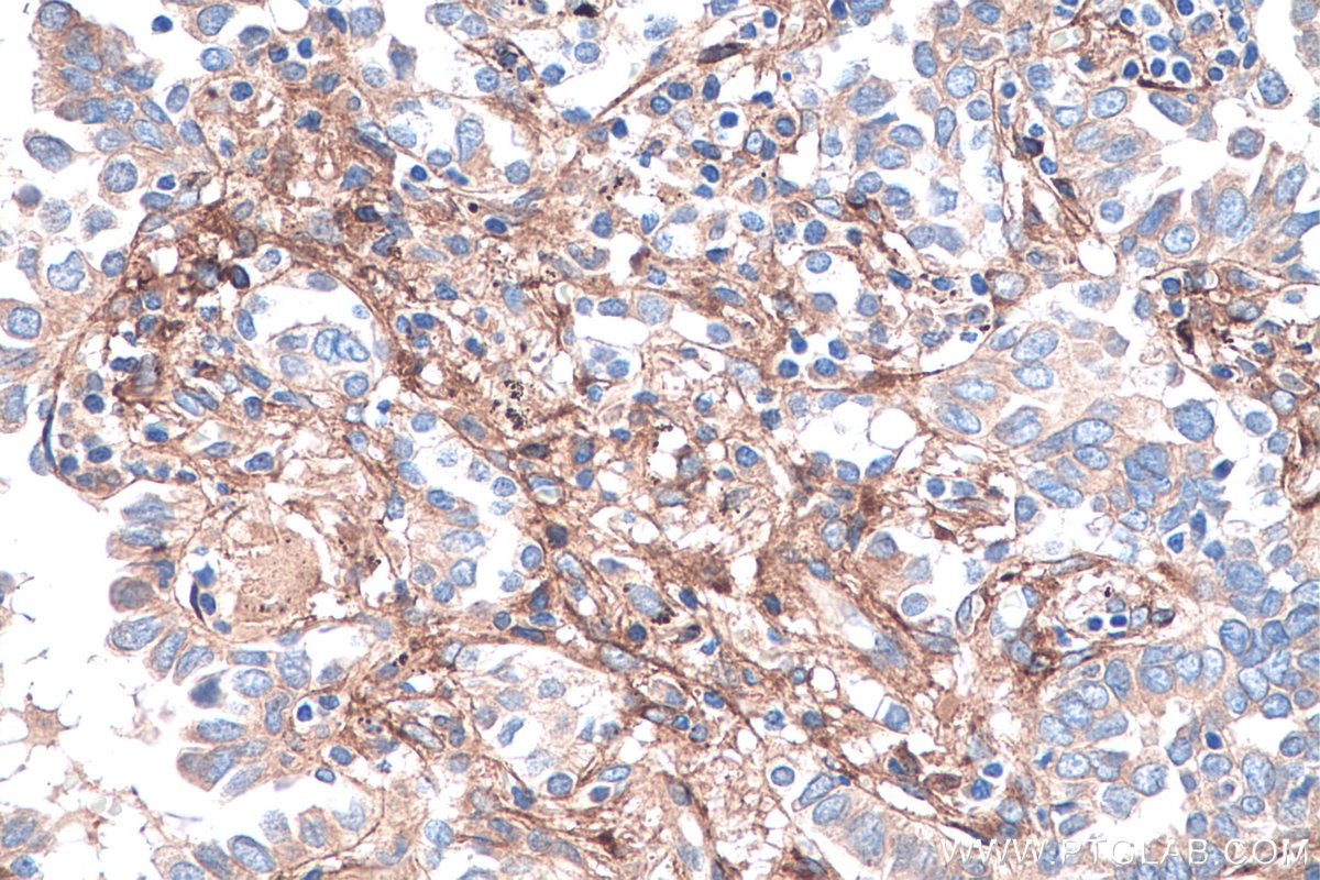 Immunohistochemistry (IHC) staining of human lung cancer tissue using Biglycan Monoclonal antibody (67275-1-Ig)