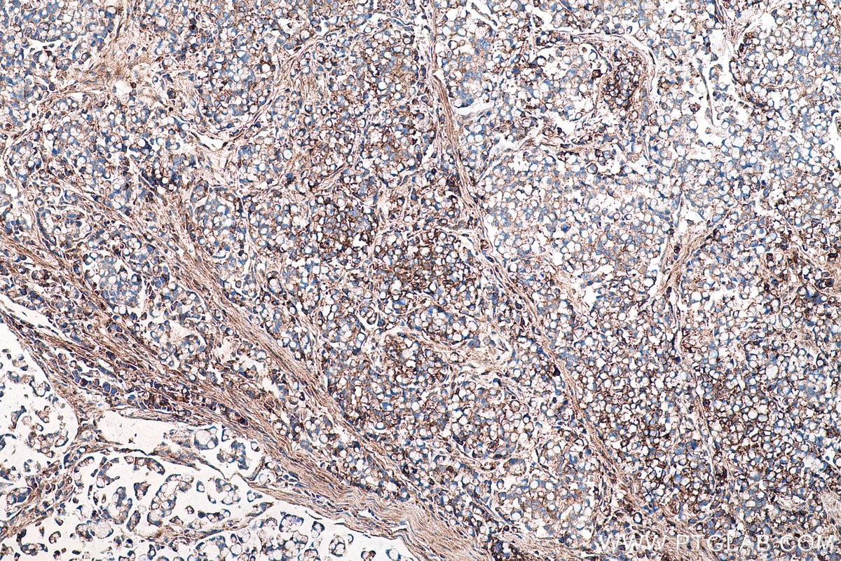 Immunohistochemistry (IHC) staining of human colon cancer tissue using Biglycan Monoclonal antibody (67275-1-Ig)