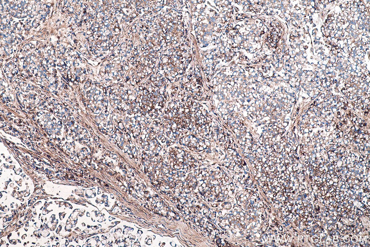 IHC staining of human colon cancer using 67275-1-Ig