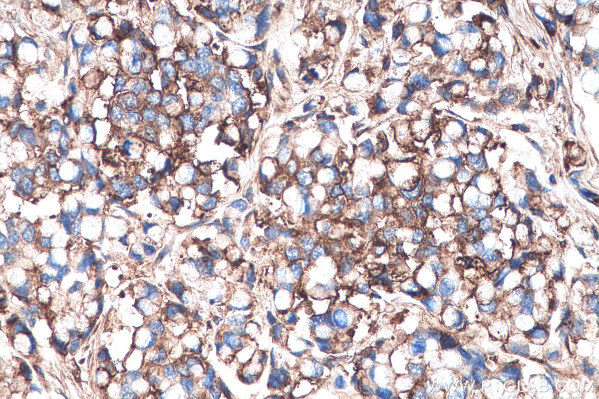 Immunohistochemistry (IHC) staining of human colon cancer tissue using Biglycan Monoclonal antibody (67275-1-Ig)