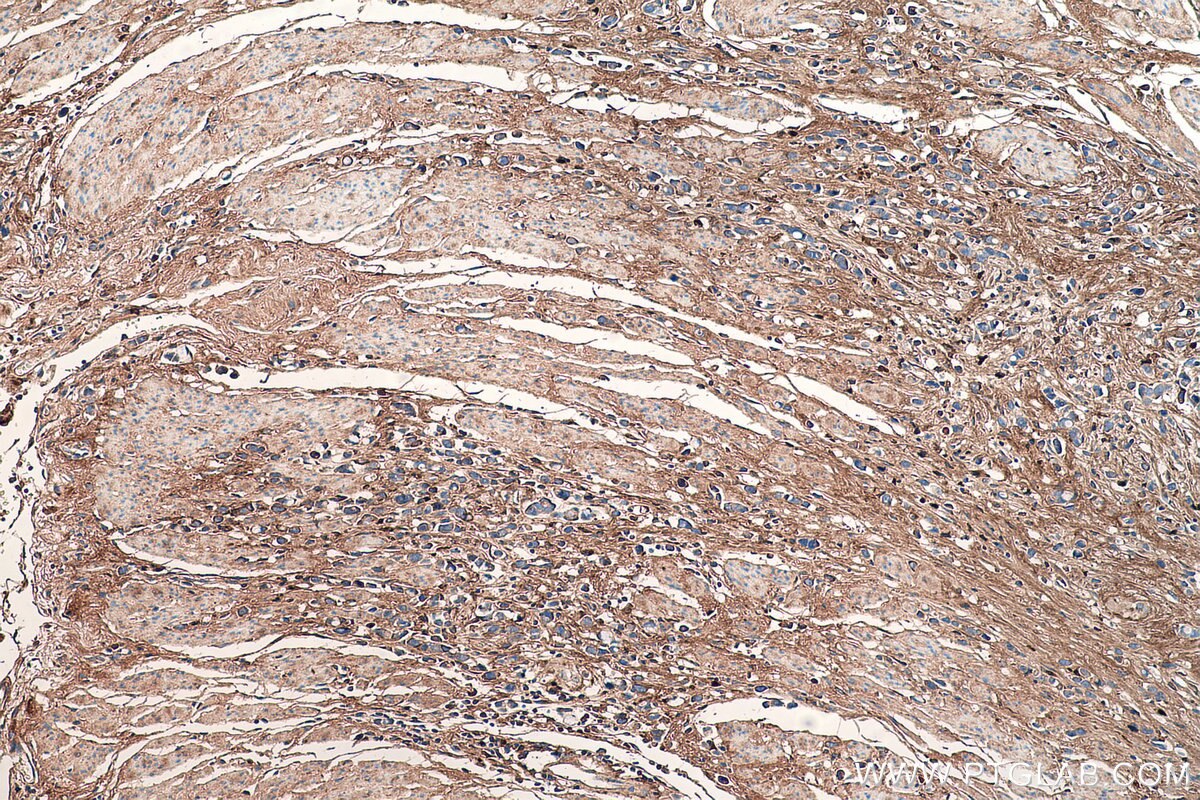 Immunohistochemistry (IHC) staining of human stomach cancer tissue using Biglycan Monoclonal antibody (67275-1-Ig)