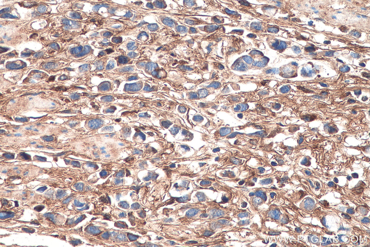 Immunohistochemistry (IHC) staining of human stomach cancer tissue using Biglycan Monoclonal antibody (67275-1-Ig)