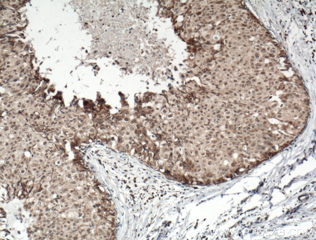 Immunohistochemistry (IHC) staining of human breast cancer tissue using Biotin-conjugated DNAJB9 Polyclonal antibody (Biotin-13157)