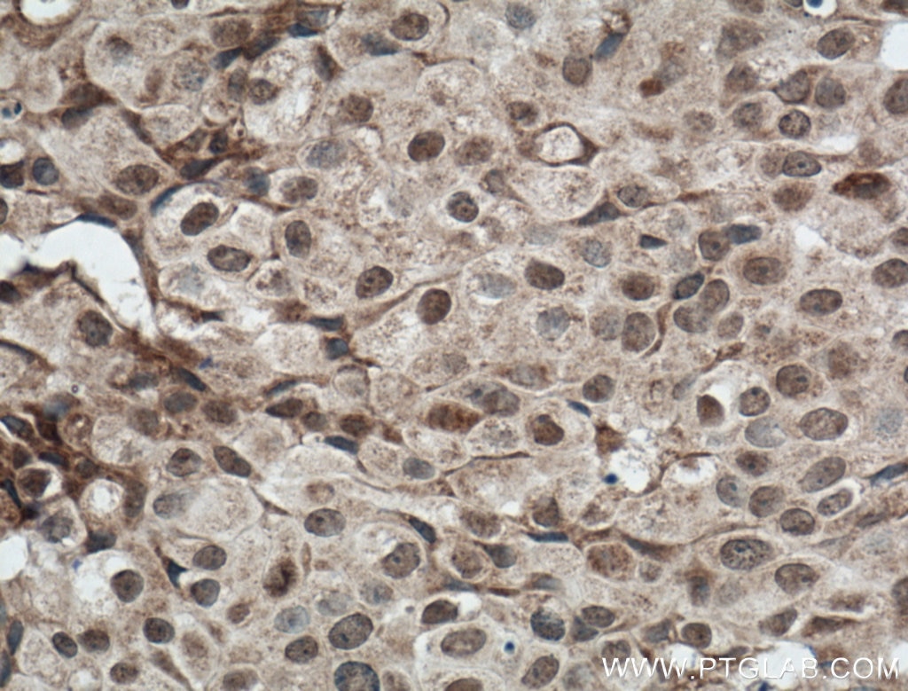 Immunohistochemistry (IHC) staining of human breast cancer tissue using Biotin-conjugated DNAJB9 Polyclonal antibody (Biotin-13157)