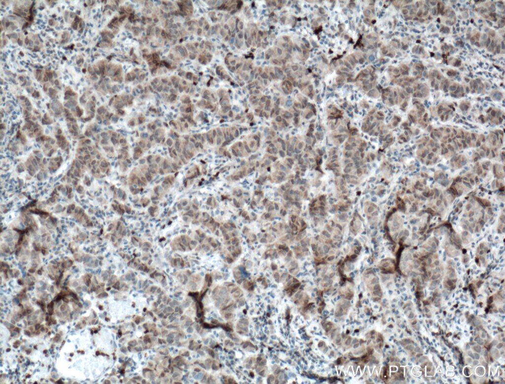 Immunohistochemistry (IHC) staining of human prostate cancer tissue using Biotin-conjugated DNAJB9 Polyclonal antibody (Biotin-13157)