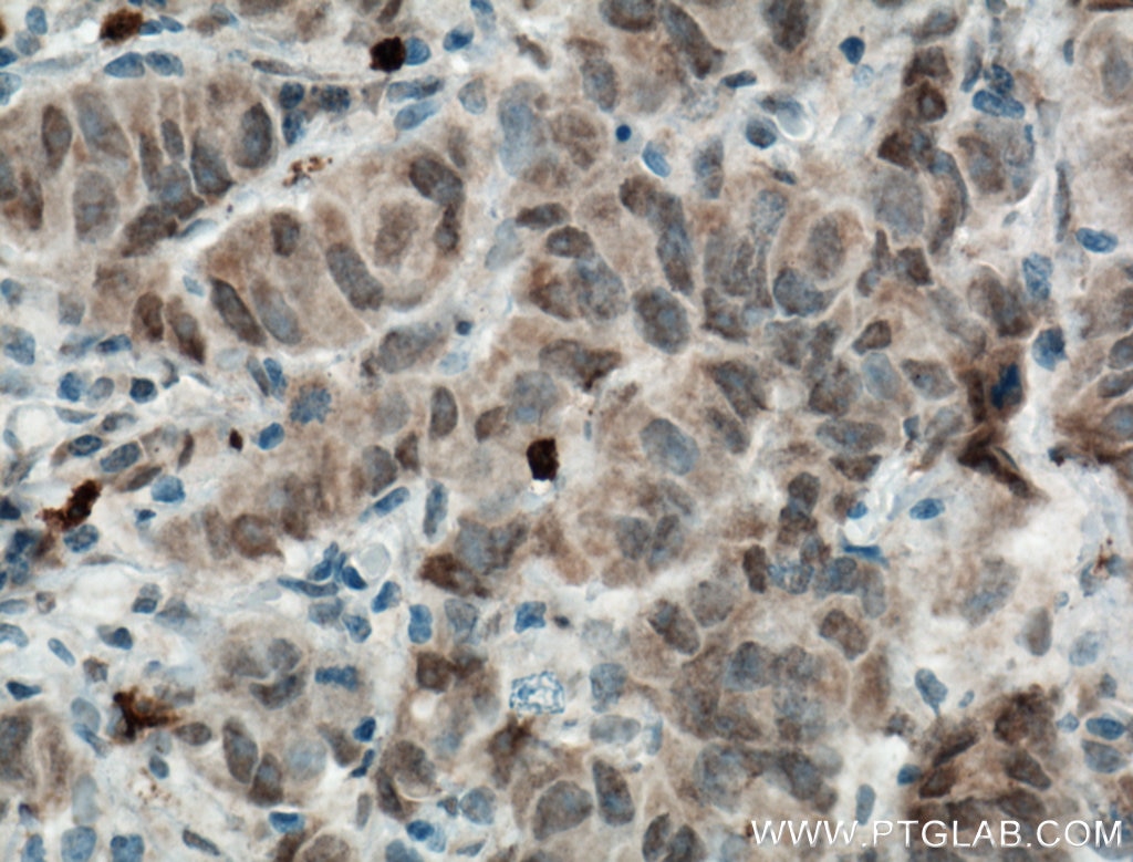 Immunohistochemistry (IHC) staining of human prostate cancer tissue using Biotin-conjugated DNAJB9 Polyclonal antibody (Biotin-13157)
