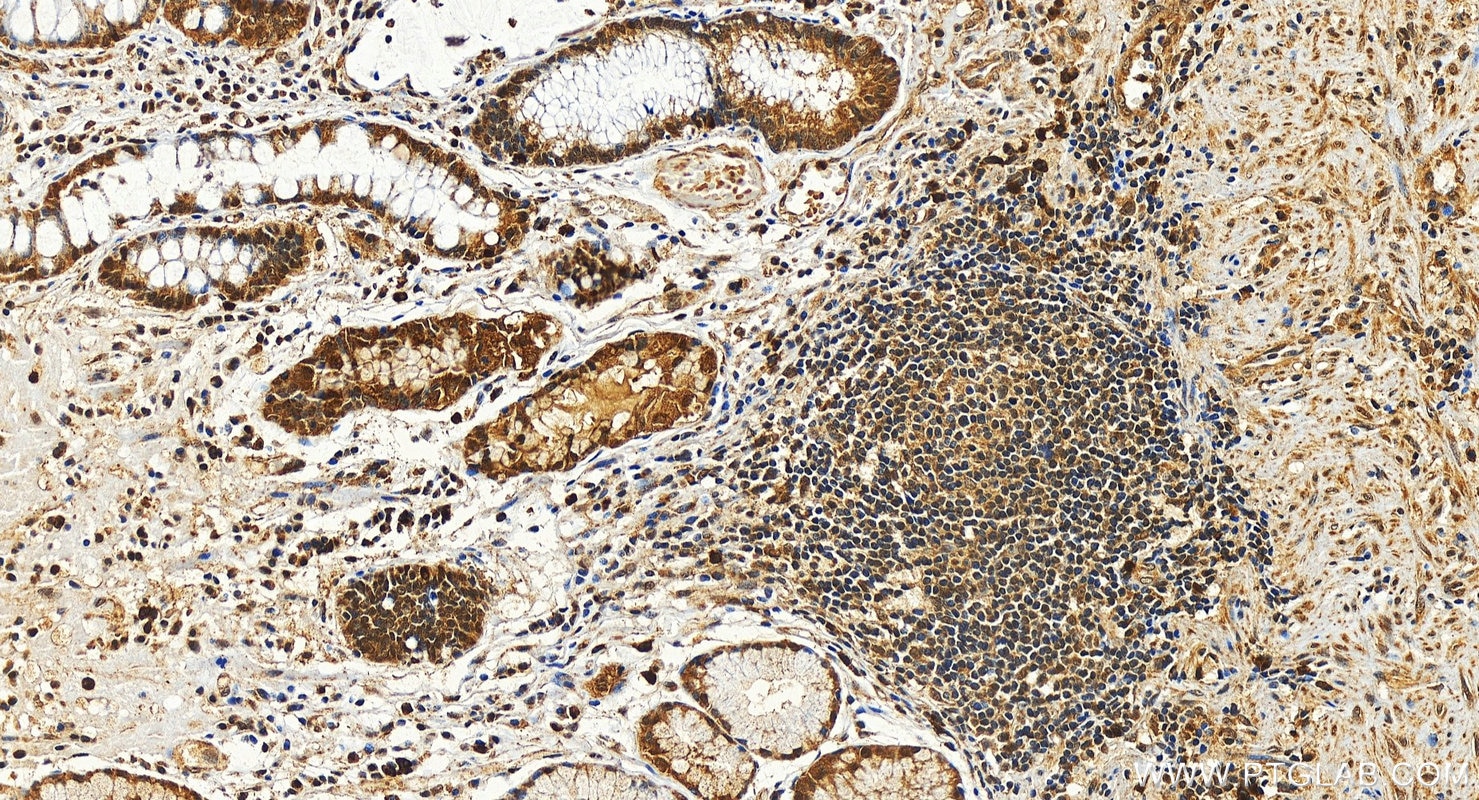 Immunohistochemistry (IHC) staining of human stomach cancer tissue using C10orf104 Polyclonal antibody (26324-1-AP)