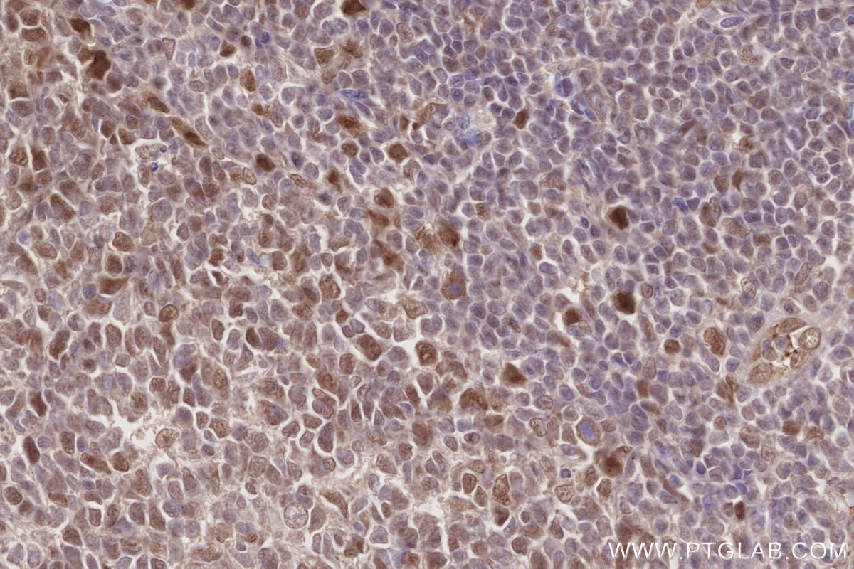 Immunohistochemistry (IHC) staining of human tonsillitis tissue using MCM-BP Polyclonal antibody (19573-1-AP)