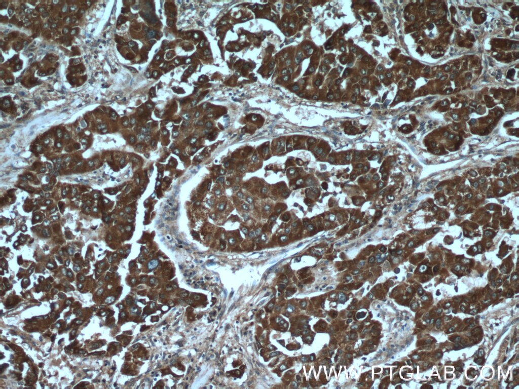 Immunohistochemistry (IHC) staining of human liver cancer tissue using C10orf125 Polyclonal antibody (24537-1-AP)