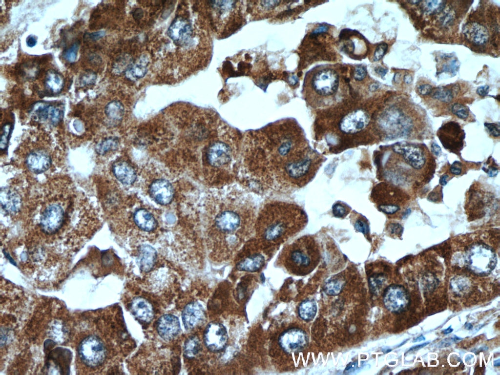 Immunohistochemistry (IHC) staining of human liver cancer tissue using C10orf125 Polyclonal antibody (24537-1-AP)