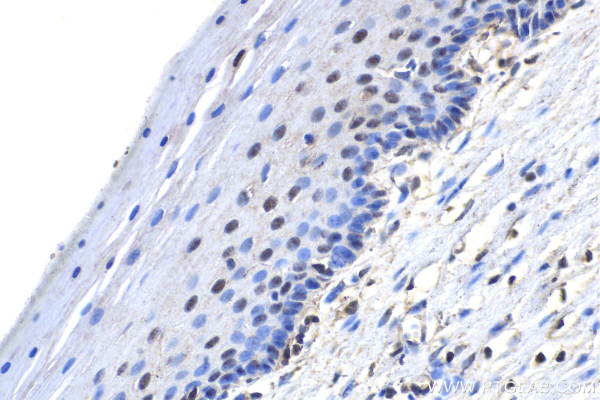 Immunohistochemistry (IHC) staining of human cervical cancer tissue using EDRF1 Polyclonal antibody (21883-1-AP)