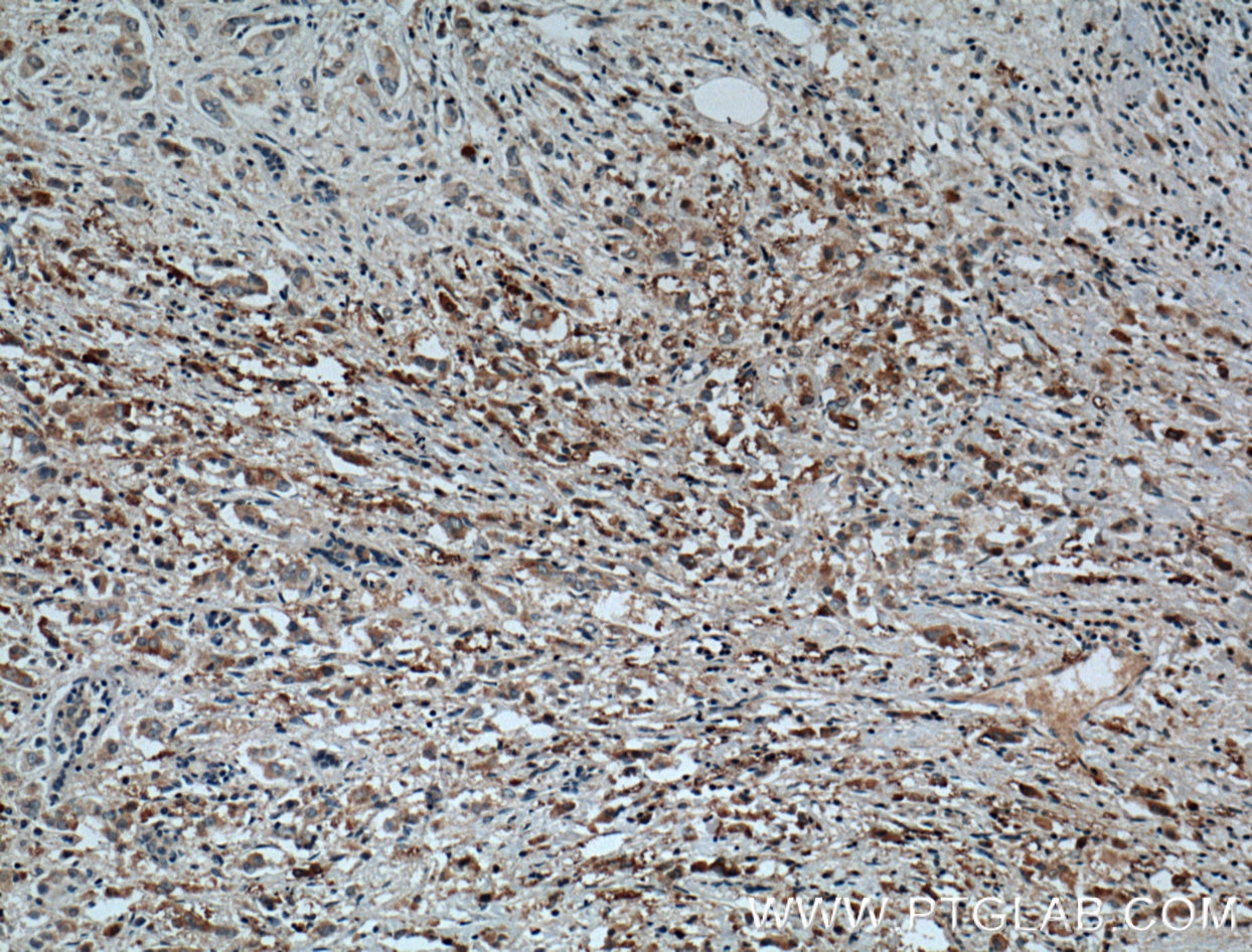 Immunohistochemistry (IHC) staining of human breast cancer tissue using C10orf18 Polyclonal antibody (20420-1-AP)