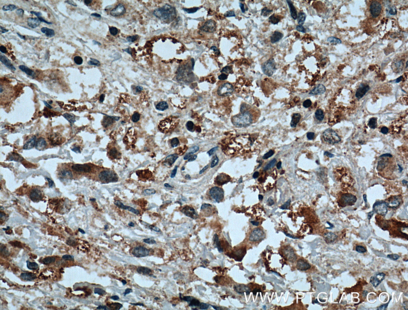 Immunohistochemistry (IHC) staining of human breast cancer tissue using C10orf18 Polyclonal antibody (20420-1-AP)