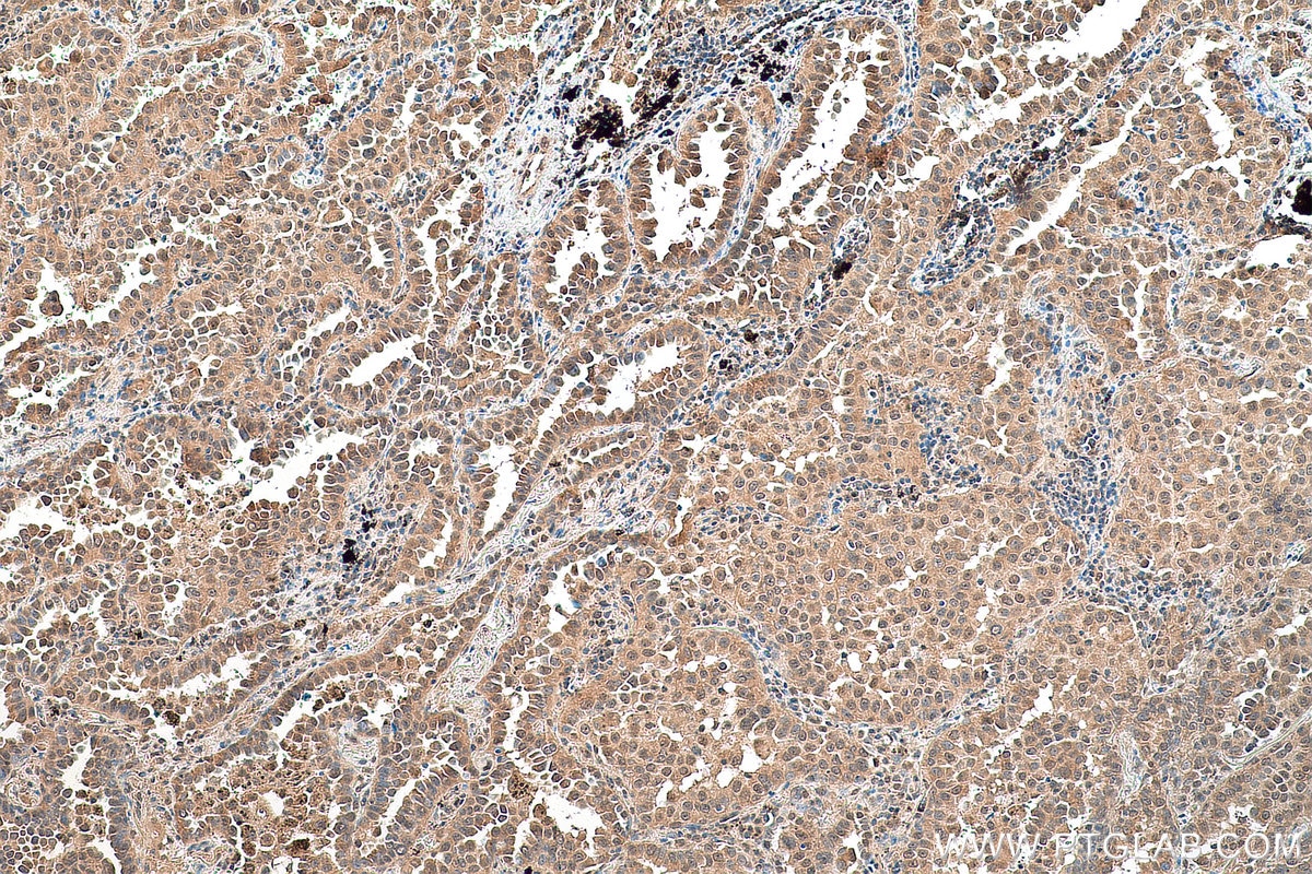 Immunohistochemistry (IHC) staining of human lung cancer tissue using C10orf27 Polyclonal antibody (24424-1-AP)