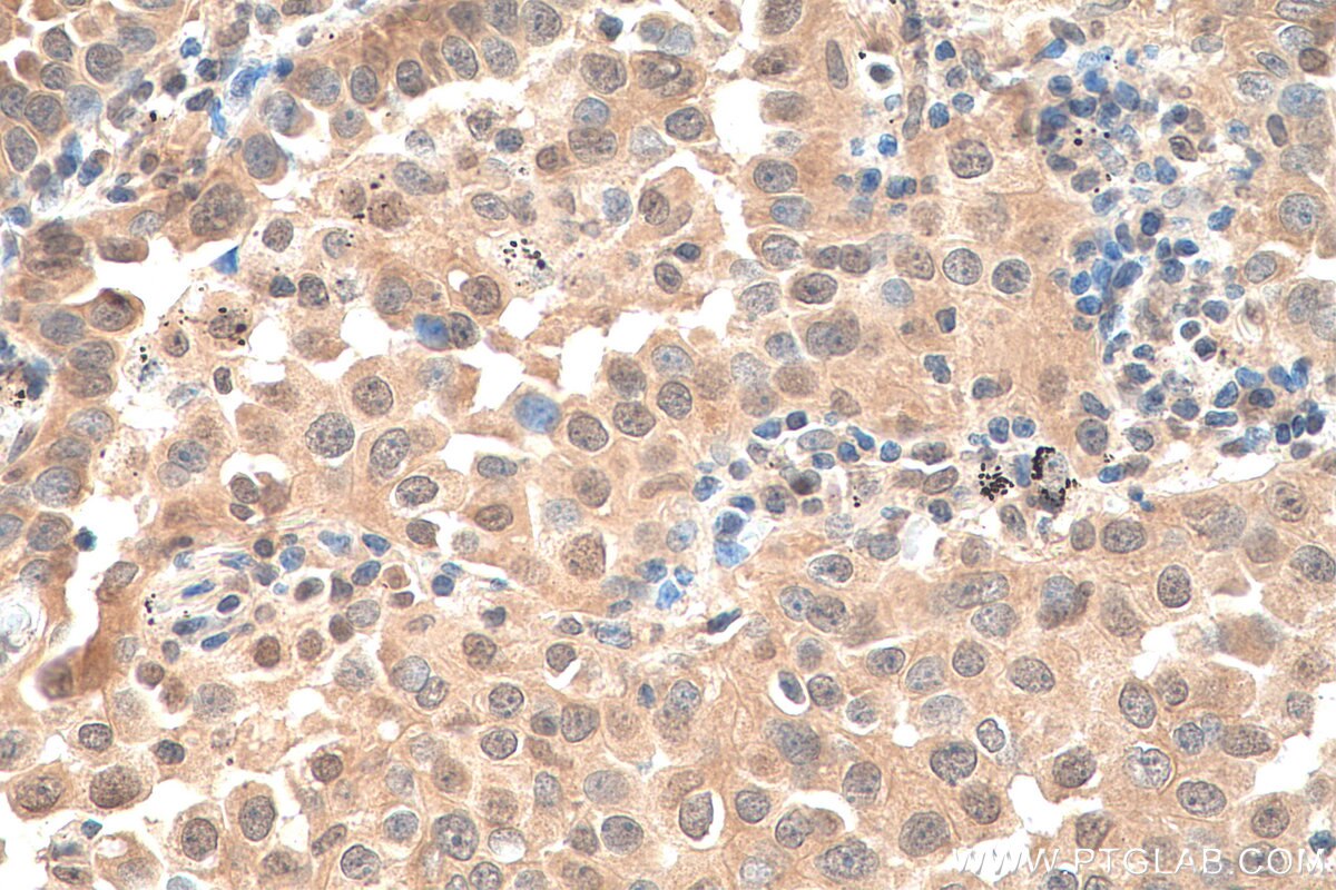 Immunohistochemistry (IHC) staining of human lung cancer tissue using C10orf27 Polyclonal antibody (24424-1-AP)