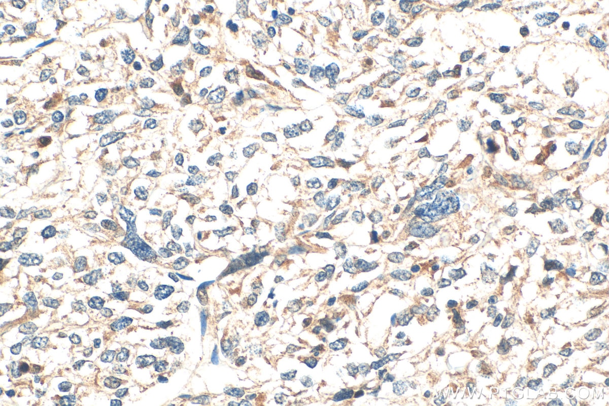 Immunohistochemistry (IHC) staining of human pancreas cancer tissue using C11orf49 Polyclonal antibody (20195-1-AP)