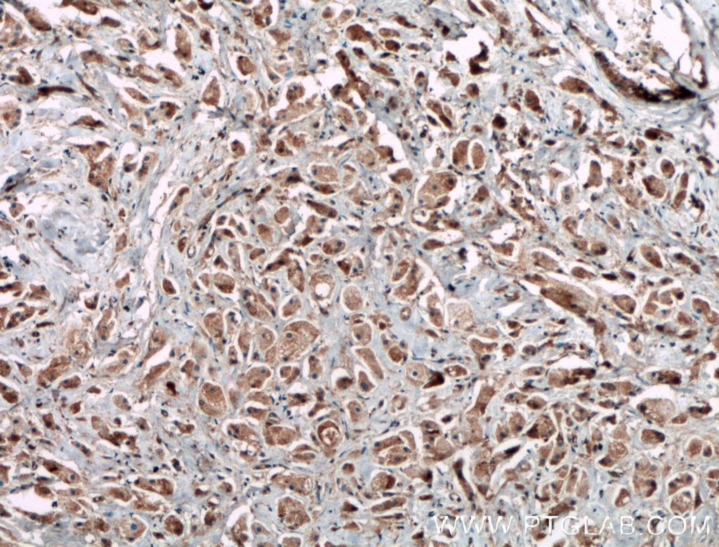 Immunohistochemistry (IHC) staining of human breast cancer tissue using C11orf57 Polyclonal antibody (21181-1-AP)