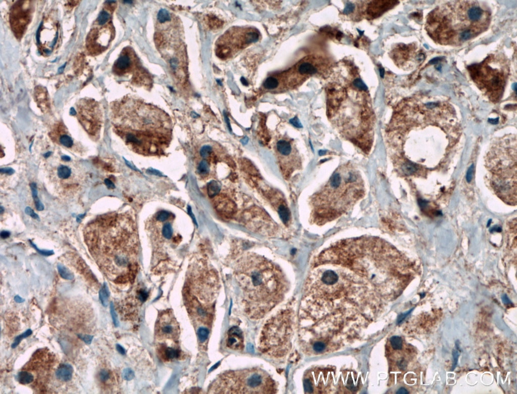 Immunohistochemistry (IHC) staining of human breast cancer tissue using C11orf57 Polyclonal antibody (21181-1-AP)