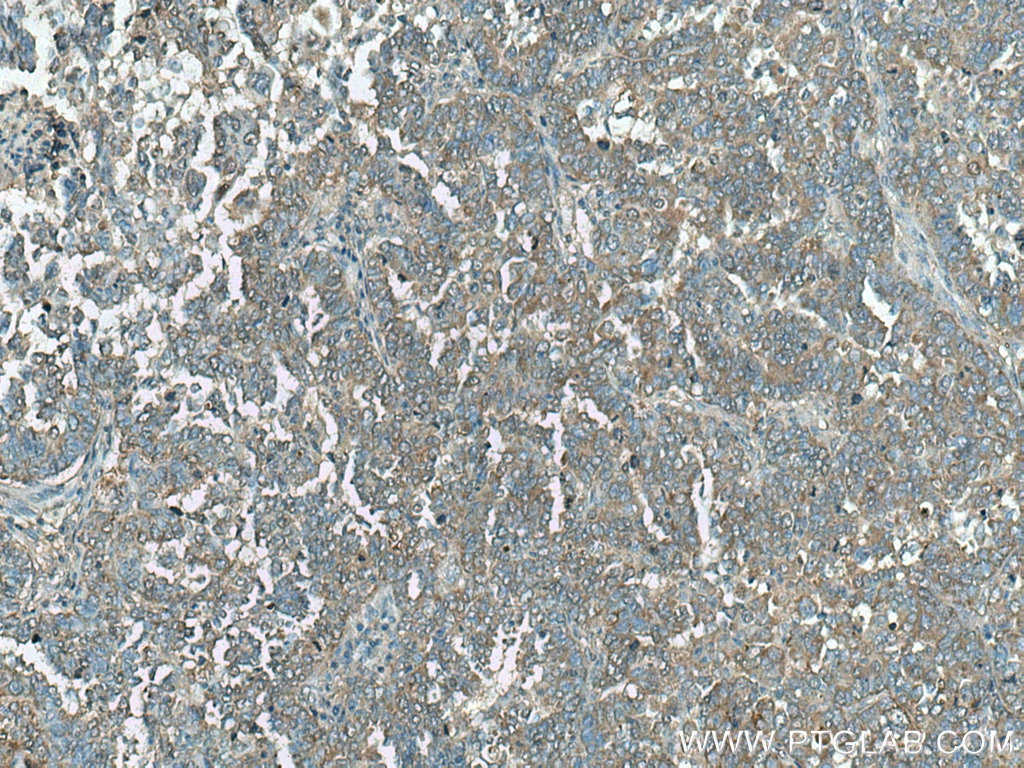 Immunohistochemistry (IHC) staining of human ovary tumor tissue using C11orf67 Polyclonal antibody (20414-1-AP)