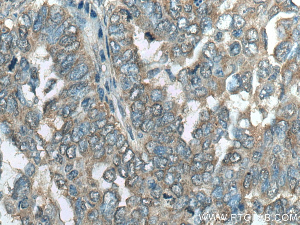 Immunohistochemistry (IHC) staining of human ovary tumor tissue using C11orf67 Polyclonal antibody (20414-1-AP)