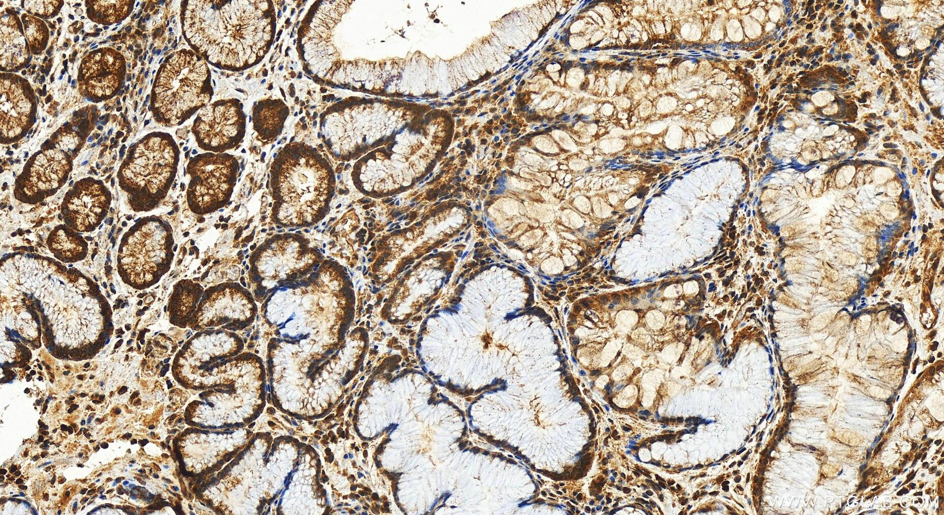 Immunohistochemistry (IHC) staining of human stomach cancer tissue using C11orf68 Polyclonal antibody (31587-1-AP)
