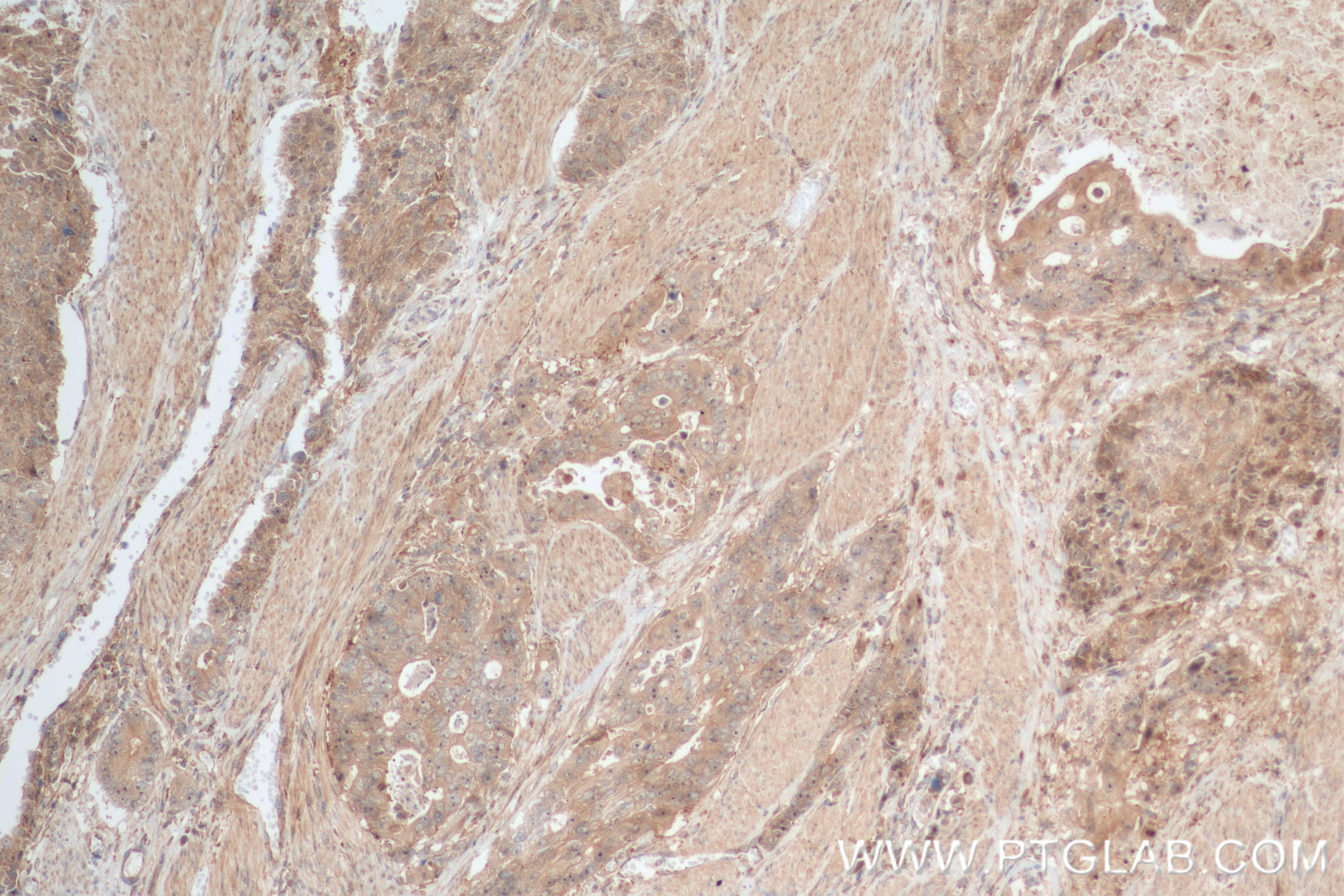 Immunohistochemistry (IHC) staining of human stomach cancer tissue using C11orf68 Recombinant antibody (84725-5-RR)